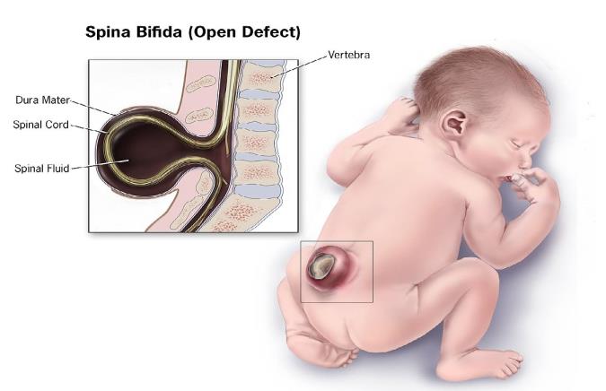 راجع به اسپینا بیفیدا چه میدانید؟