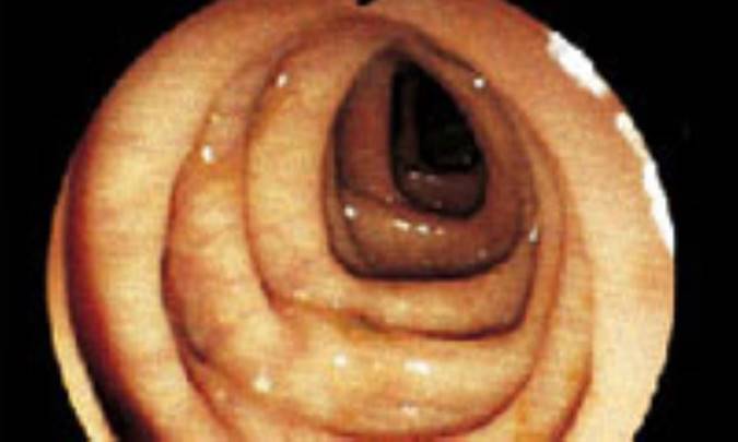 بيماري‌ ديورتيكولي‌ 