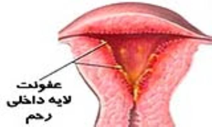 علائم عفونت باکتریایی واژینال