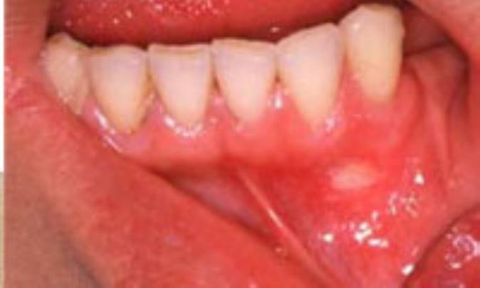 رابطه شيمي‌درماني و زخم‌هاي دهاني