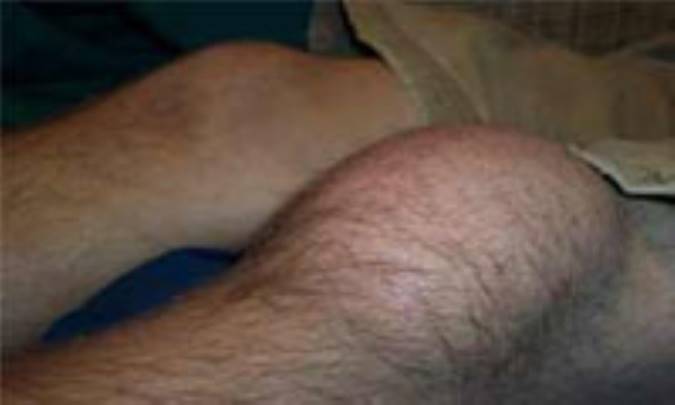 بورسيت (التهاب بورسا: كيسه‏ى موجود بين تاندون و استخوان)