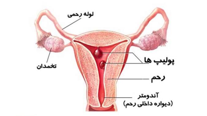 علل، علایم و درمان پولیپ های رحم (پولیپ آندومتر)