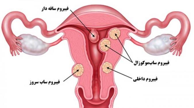 فیبروئیدها در رحم و تخمدان