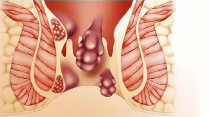 همه چیز درباره بواسیر یا هموروئید