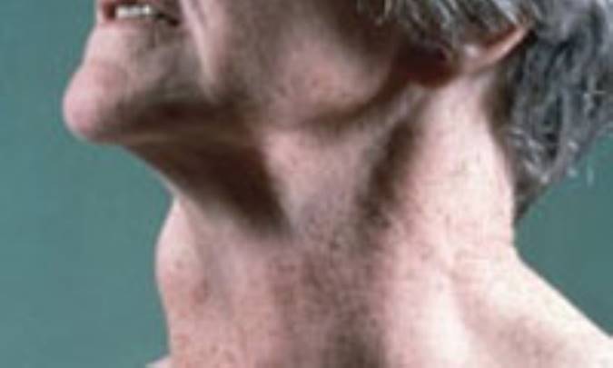 بیماری هاشیموتو چیست؟ 