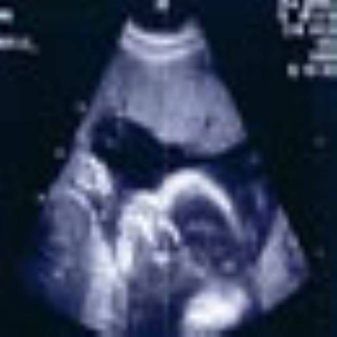 تغييرات پستان در دوران بارداري