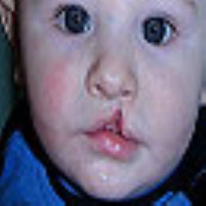 شکاف کام ولب لب شکری