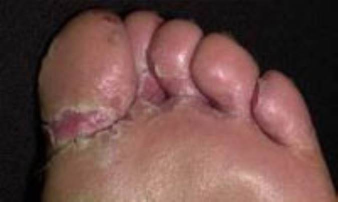 عفونت هاي قارچي پوست