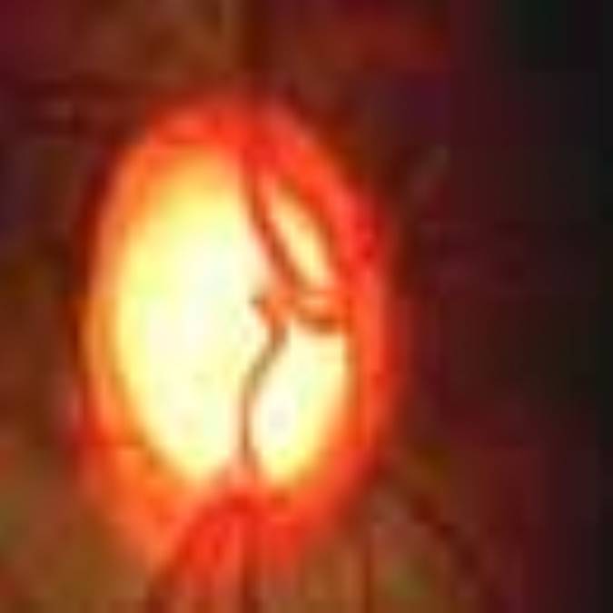 آب‌ سياه‌ چشم‌، نوع‌ مزمن‌ زاويه‌ باز