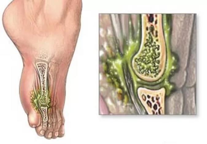 علائم ، علل و درمان بیماری استئومیلیت یا عفونت استخوان