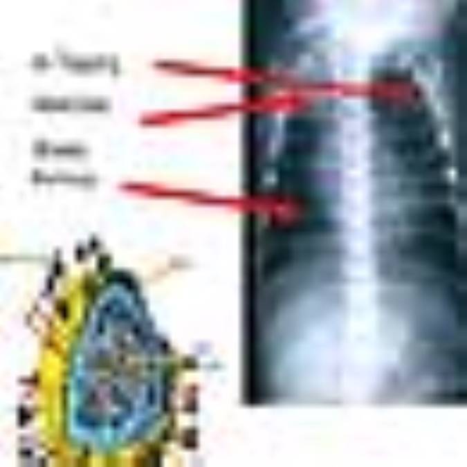 ادم‌ ريه: ‌ pulmonary edema