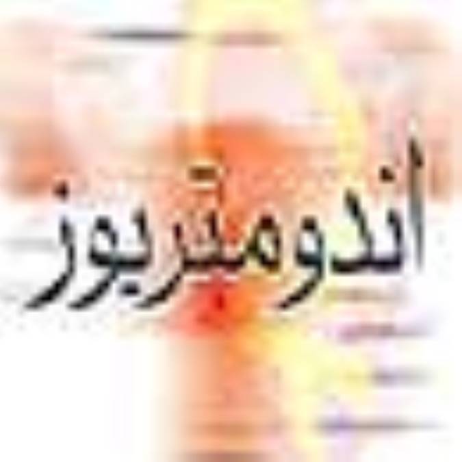 آندومتريوز(Endometriosis)