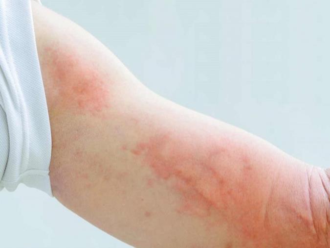 کهیر چیست و چگونه درمان می‌شود؟