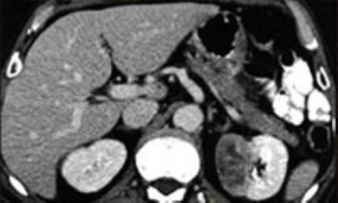 كارسينوم‌ كليه‌ 