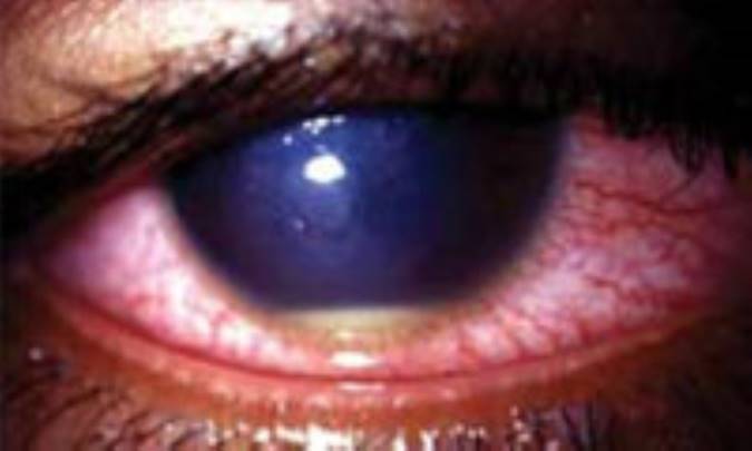 التهاب‌ قرنيه‌ (كراتيت‌)