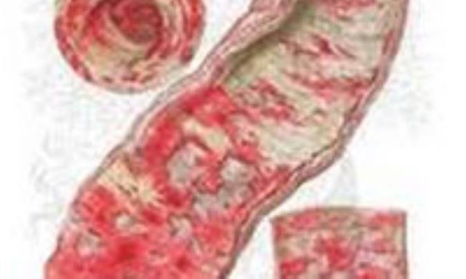 اسهال‌ خوني‌ باكتريايي‌ (شيگلوز)