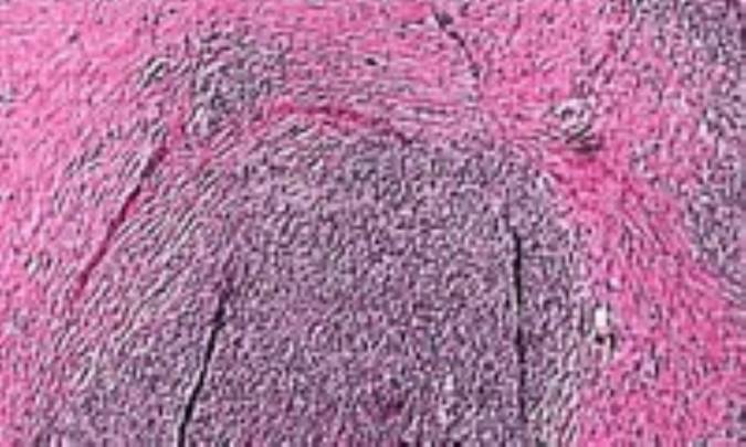 بيماري‌ هوچكين‌