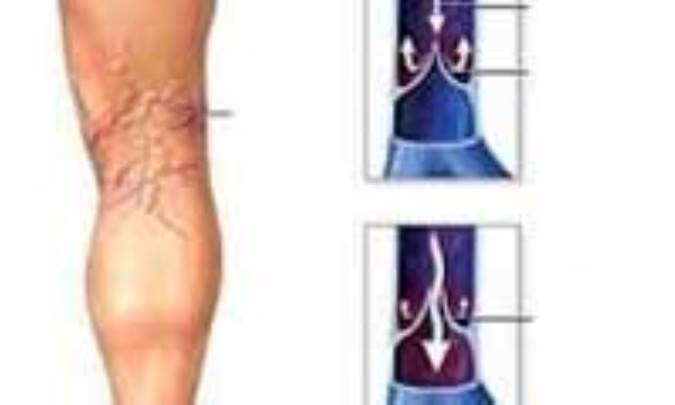 واريس