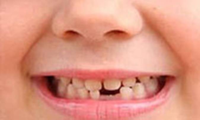 دندانهاي پوسيده ،سوغات مدرسه