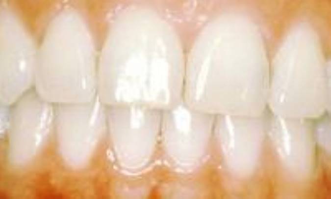 لثه‌ها و لبخندها