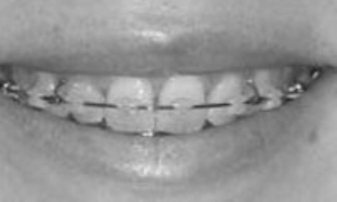 تازه‌ترين تکنيک ارتودنسي