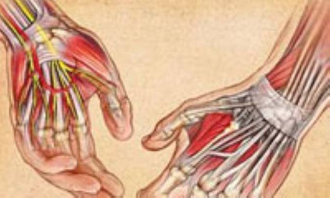 تندينيت (التهاب تاندون)