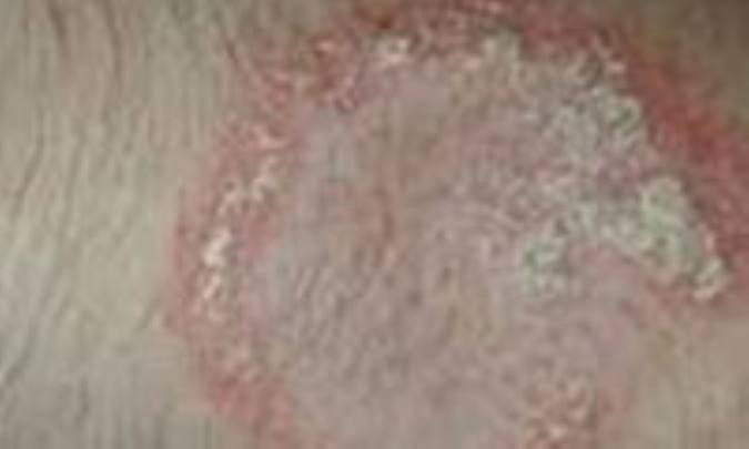 پسوريازيس (يك بيمارى مهم پوستى)