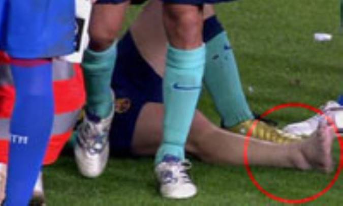 آسیب دیدگی مچ پا Ankle Sprain 