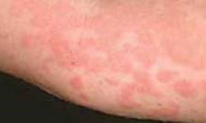 اگزماي پوست