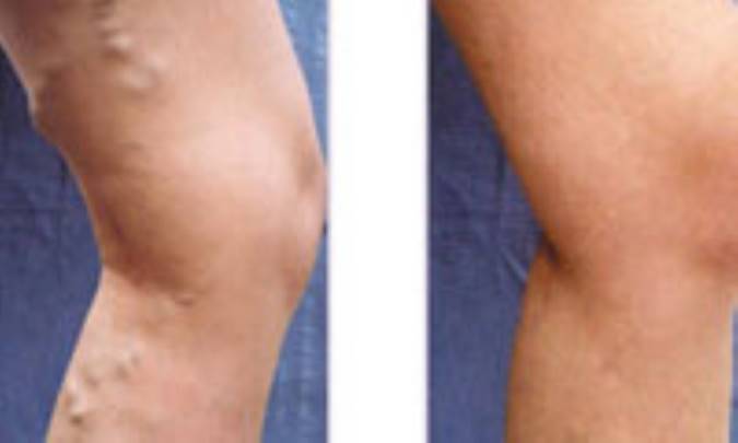 كم تحرك ها در معرض ابتلاء به واريس