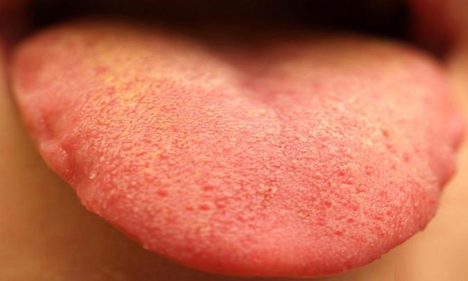 زردی زبان علائم و راه های درمان آن