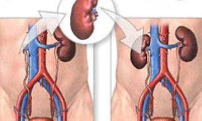 عوارض پيوند کليه