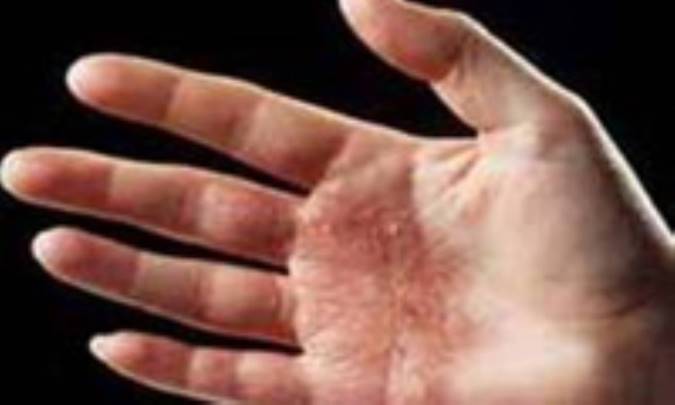 بيماري خانم‌هاي خانه‌دار