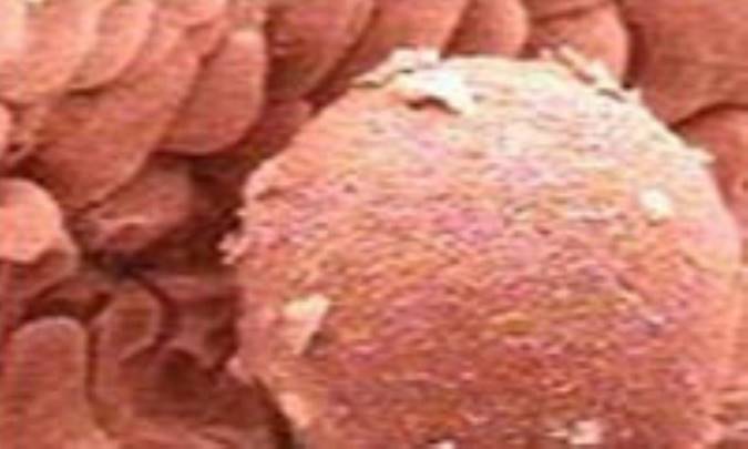 سرطان تخمدان در کمين زنان چاق