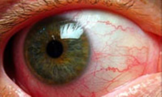 التهاب‌ عنبيه‌