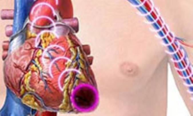 پريكارديت‌ حاد