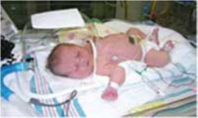 NICU يعني ICU نوزادان