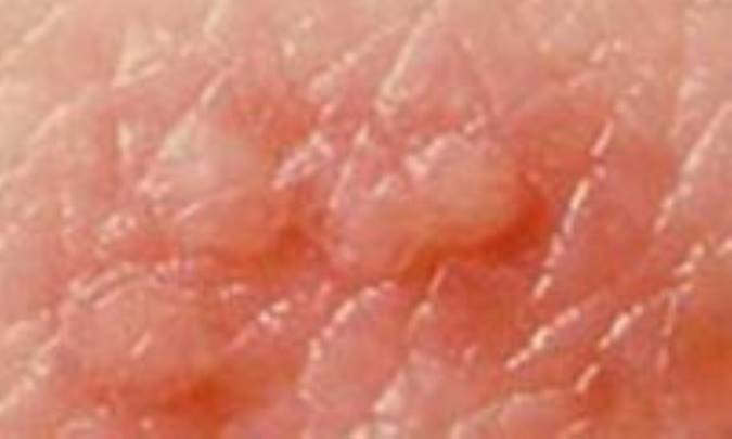 زونا، بيماري پوستي با درد اضافه