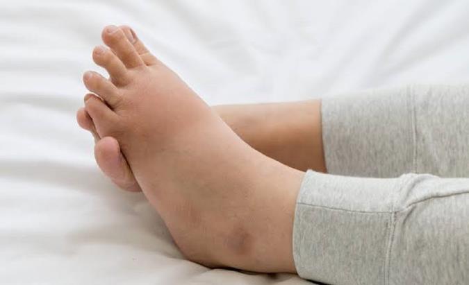 چگونه از ورم پا در مسافرت با ماشین، قطار و ... پیشگیری کنیم؟