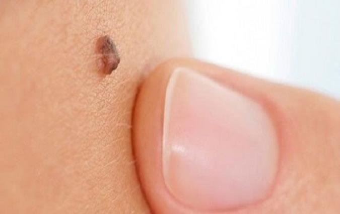 خال سرطانی چیست؟