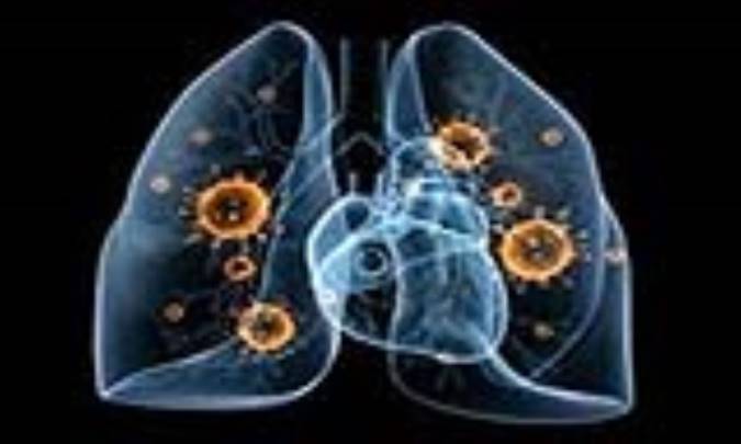 عفونت باکتریایی ریه