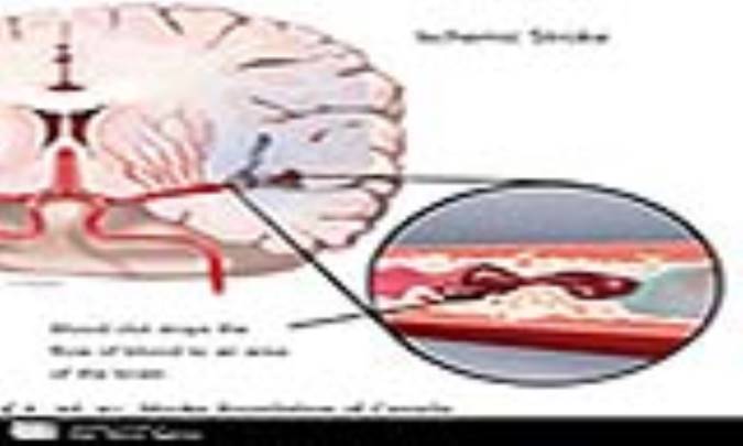 ویتامین E و کاهش احتمال سکتة قلبی