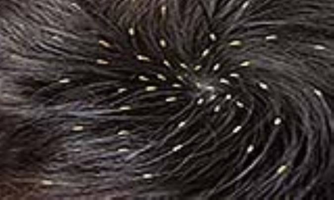 چگونه از شر شپش سر خلاص شویم؟