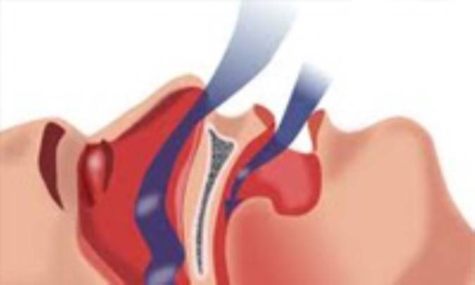 ارتباط گلوکوم با آپنه مزمن