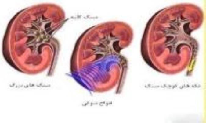 نارسایی کلیه ها را جدی بگیرید!