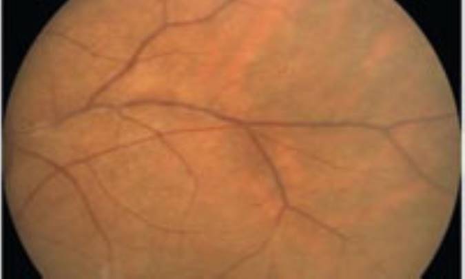   احتمال تشخیص ام‌اس در بیماران مبتلا به بیماری التهابی چشم