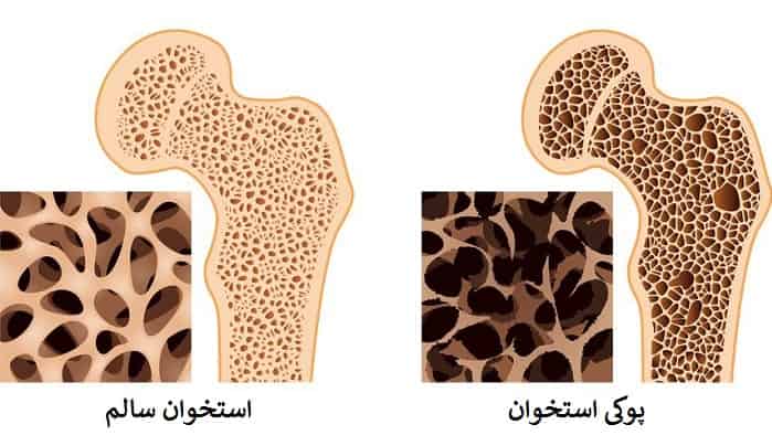 علل و درمان پوکی استخوان