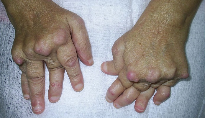 با بیماری روماتیسم آشنا شوید