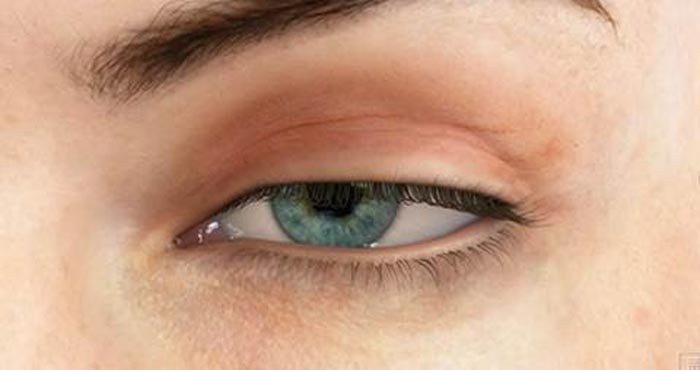 با انواع افتادگی پلک و راه های درمانی آن آشنا شوید