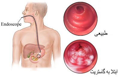 درمان گاستریت معده